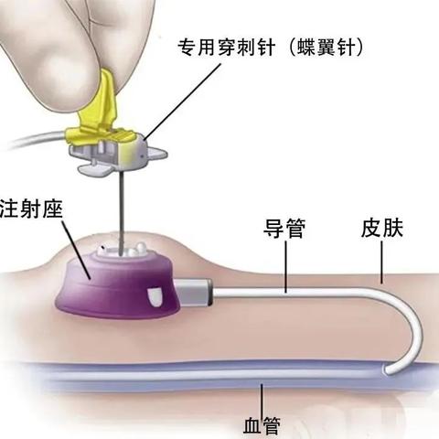 西宁市第一人民医院---“家门口”的静脉治疗护理门诊