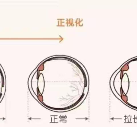 临桂区中庸镇文昌小学近视防控知识宣传——致家长的一封信