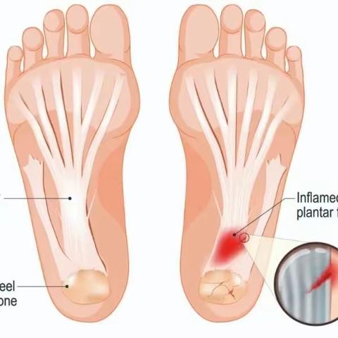 足底筋膜炎的诊断与治疗，看这篇就够了