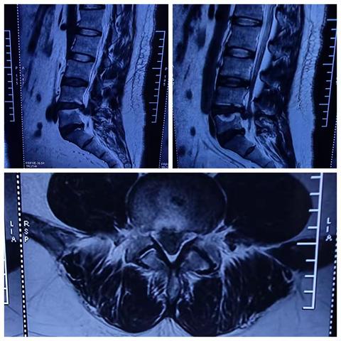 腰椎间盘突出患者治疗新选择