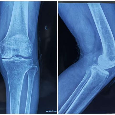 榆林市榆阳区人民医院   关节与运动损伤 ————保膝篇