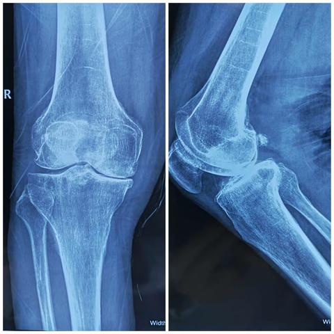 榆林市榆阳区人民医院    榆林市儿童医院    关节与运动损伤科独立完成首例膝关节单髁表面置换术  ——保膝篇（二）：膝关节单髁表面置换术