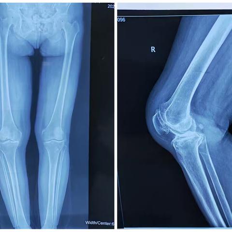 榆林市榆阳区人民医院医院  关节与运动损伤科 ——保膝篇（二）：膝关节单髁表面置换术