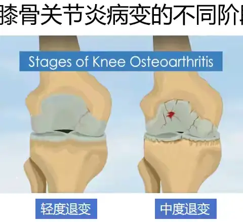 世界骨关节炎日——爱护关节，远离关节炎！