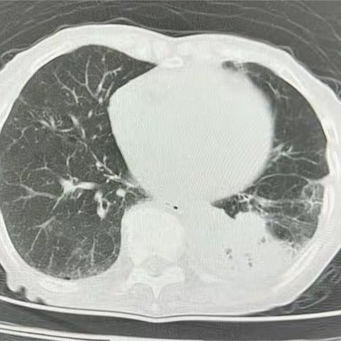 气管镜活检典型病历报告