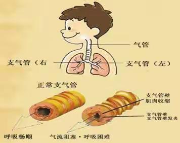 急性支气管炎的护理