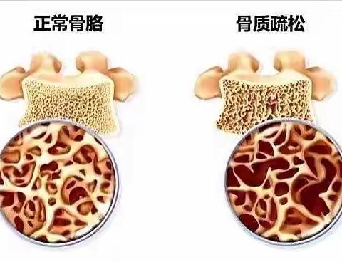 如何预防骨质疏松