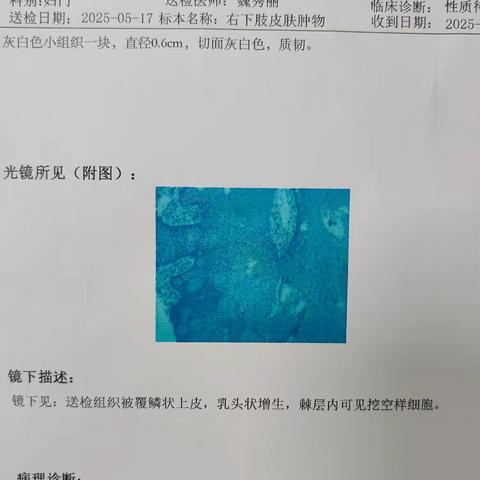 皮肤肿物病理检查相关场景介绍