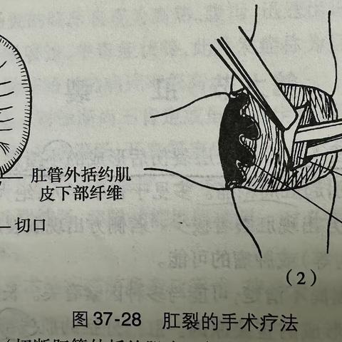 肛裂