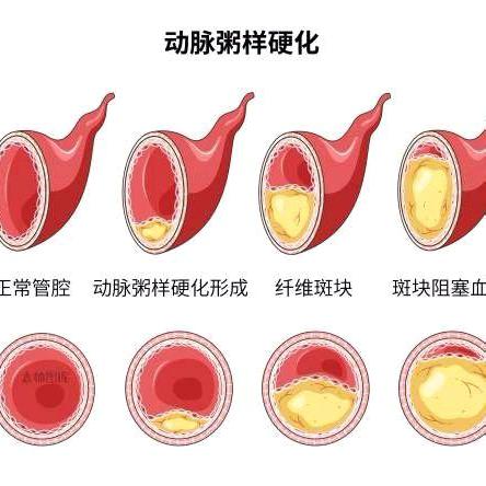 不要谈斑色变，发现颈动脉斑块，怎么办？