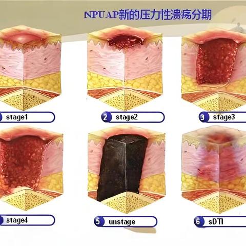 悬浮床：压力性损伤患者的守护天使