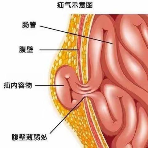腹股沟斜疝健康宣教