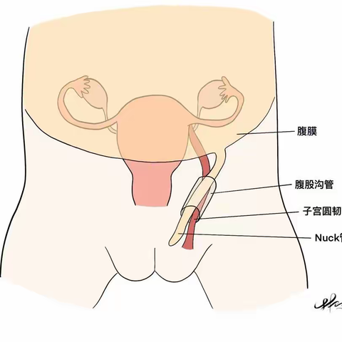 小儿卵巢疝