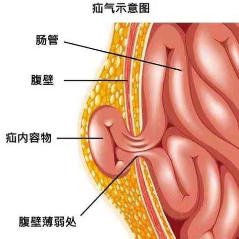 兰考第一医院急诊外科开展“腹腔镜下腹股沟疝修补术”