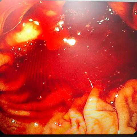 生死时速：急诊内镜下止血，抢回生命线！