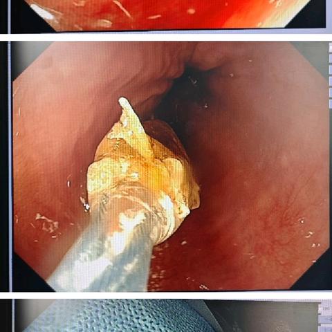 枣核虽小，能伤脏腑；胃镜妙手，化险为夷——24小时内镜急救，守护消化道安全！