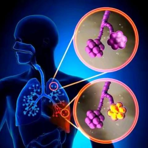 CT发现肺结节如何随访？