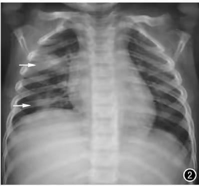 孩子发烧咳嗽，拍X线片还是做CT？