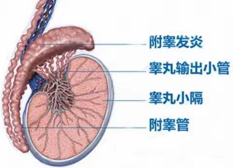 急性附睾炎的健康宣教