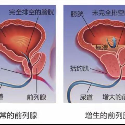 前列腺增生的健康宣教