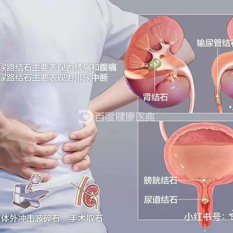 肾、输尿管结石健康宣教