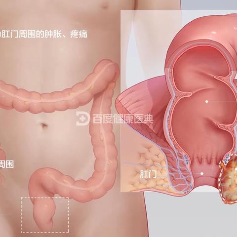 肛周脓肿健康宣教