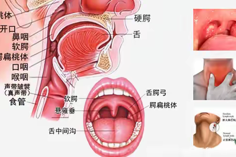 慢性扁桃体炎