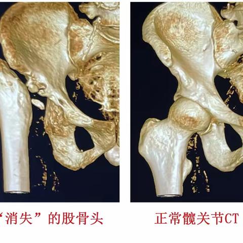 罕见病例 | 变短的腿，消失的股骨头