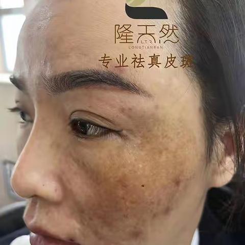 隆天然细胞更新+美肌液，治疗黄褐斑铅汞中毒斑对比照