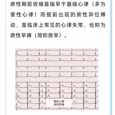 房性早搏