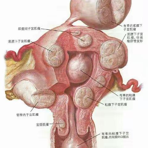一例巨大子宫肌瘤切除术——手术分享