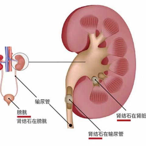 健康大讲堂——妊娠期结石的预防