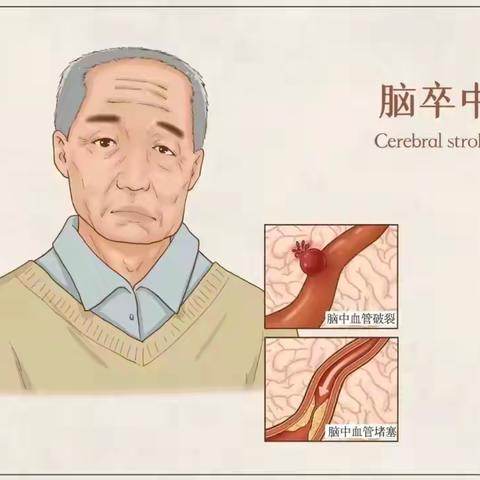 脑卒中患者步行训练 ‍