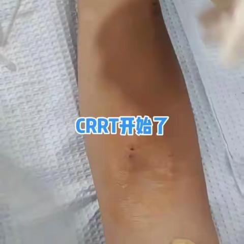 我们肾内科的终极神器：CRRT