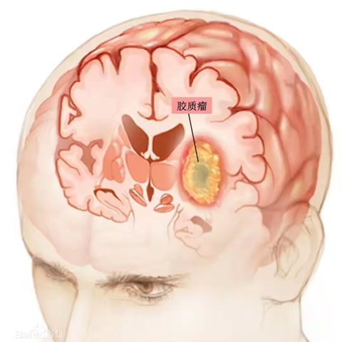 脑胶质瘤很可怕？早诊早治搞定TA！
