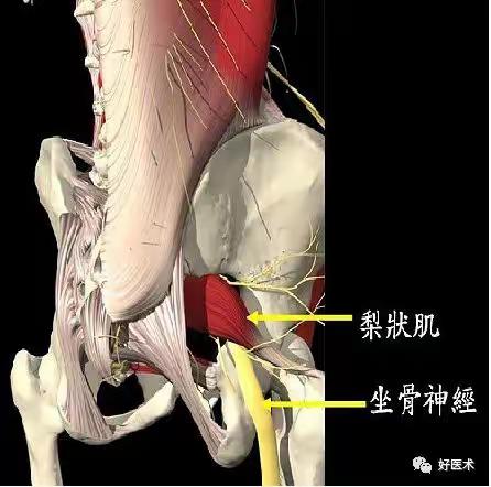 梨状肌综合征