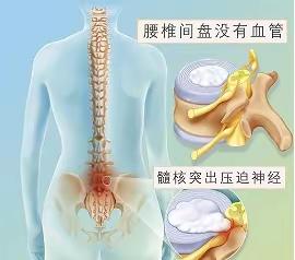 腰椎间盘突出--中医特色疗法