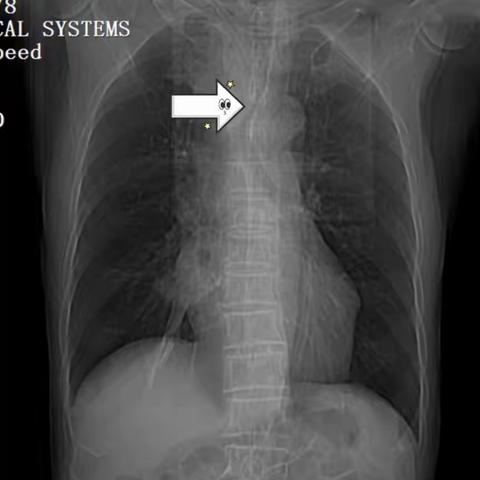 呼吸困难病人置入Y型气管支架治疗一例