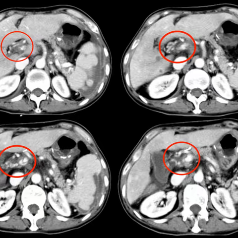 门脉海绵样变TIPS手术病案分享1例