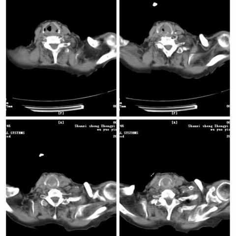 喉癌的放射性粒子植入治疗两例
