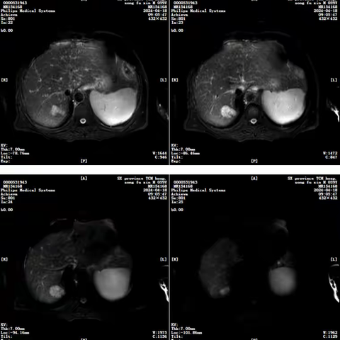 AFP断崖式下降！TACE联合微波消融：肝癌治疗的'精准双杀'，肿瘤信号消失无踪！