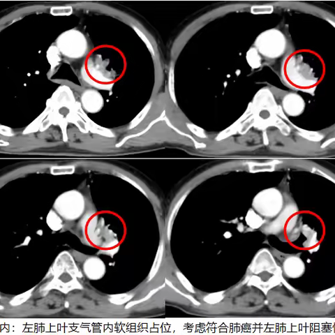 “米粒神奇立大功”！肺癌肿瘤神奇“蒸发”，粒子植入术让癌症患者重获新生！