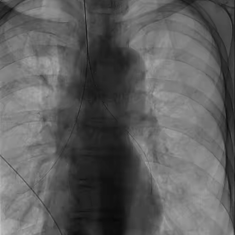 肿瘤患者“食管气管瘘”危在旦夕？介入微创“补天术”立竿见影！