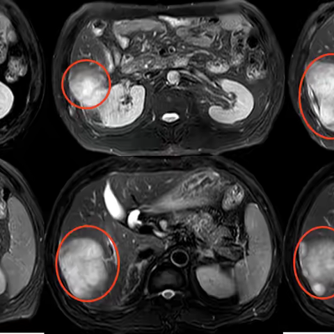 肝转移≠绝望重点！HAIC技术为晚期结肠癌患者打开生命“新窗口”