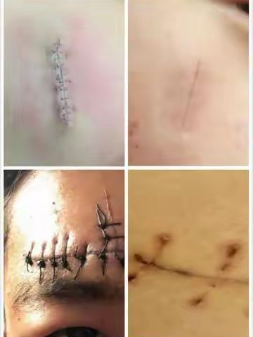 普通缝合与美容缝合的区别你知道吗？