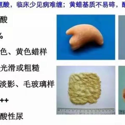 结石成分分析很重要----科学预防尿结石的“法宝”！
