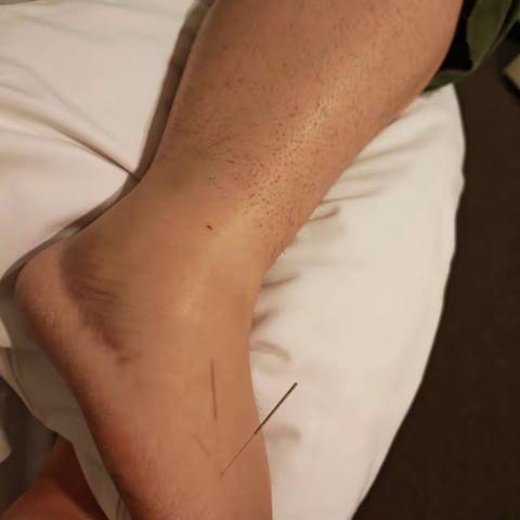 陆飚医案：足跟肌腱部分撕裂伤