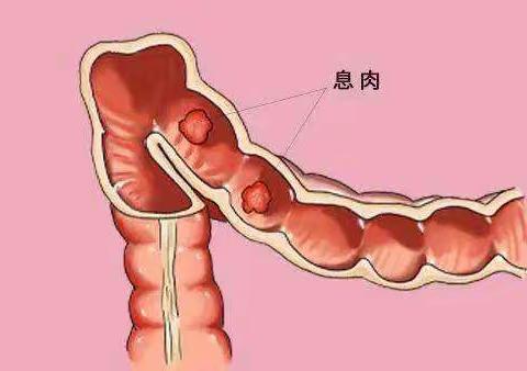 发现一例早癌，挽救一个家庭，肠息肉，不经意间就会癌变！【科普】冕宁漫水湾友松医院