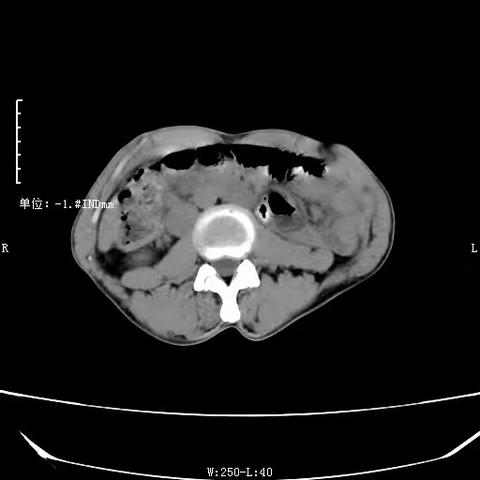 异位肾病例分享