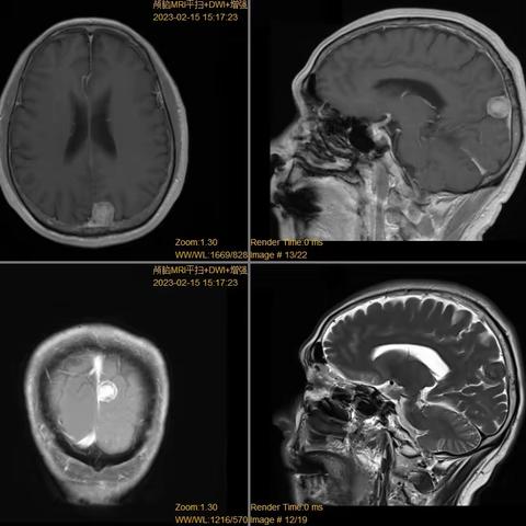 近期部分神经肿瘤和脑血管病手术病例分享